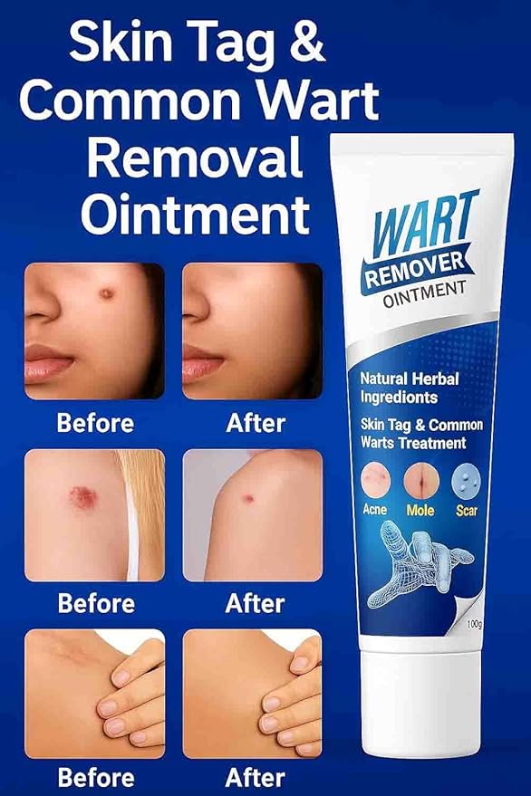 (Pack of 2) Wart Remover Cream