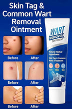 (Pack of 2) Wart Remover Cream
